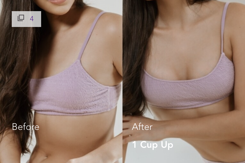 Mia Femtech Breast Implant Harmonization Before After