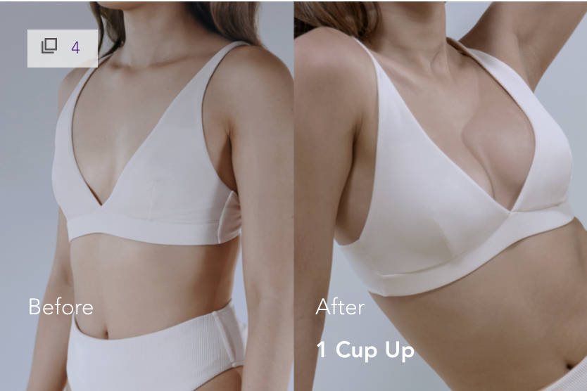 Mia Femtech Breast Implant Before After 2026