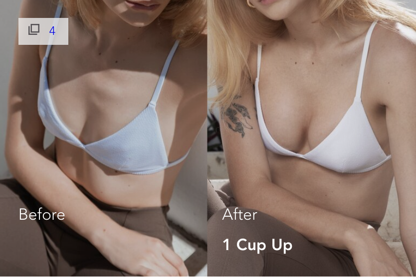 Mia Femtech Breast Implant Harmonization Before After