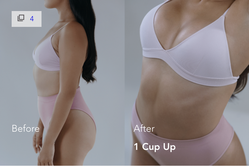 Mia Femtech Breast Implant Harmonization Before After