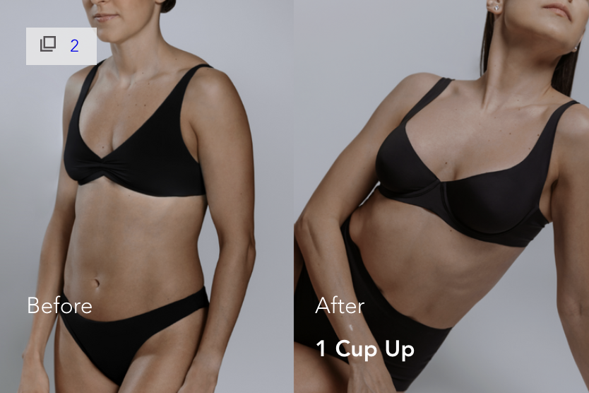 Mia Femtech Breast Implant Harmonization Before After