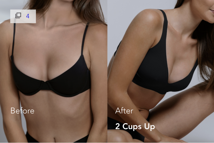 Mia Femtech Breast Implant Harmonization Before After